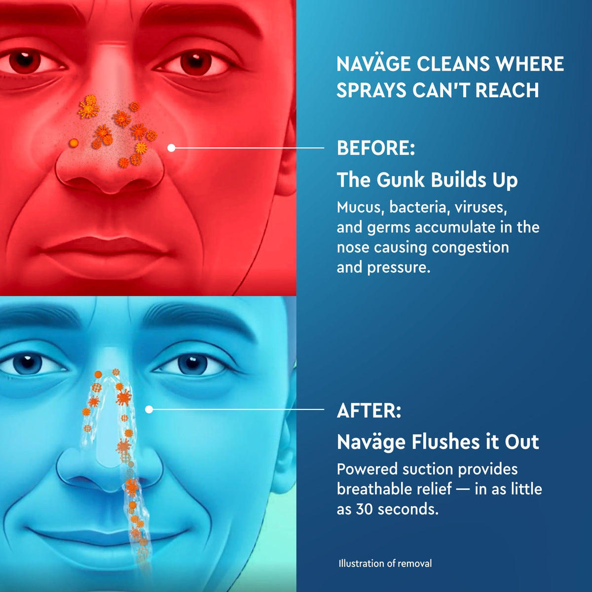 Nose Cleaner